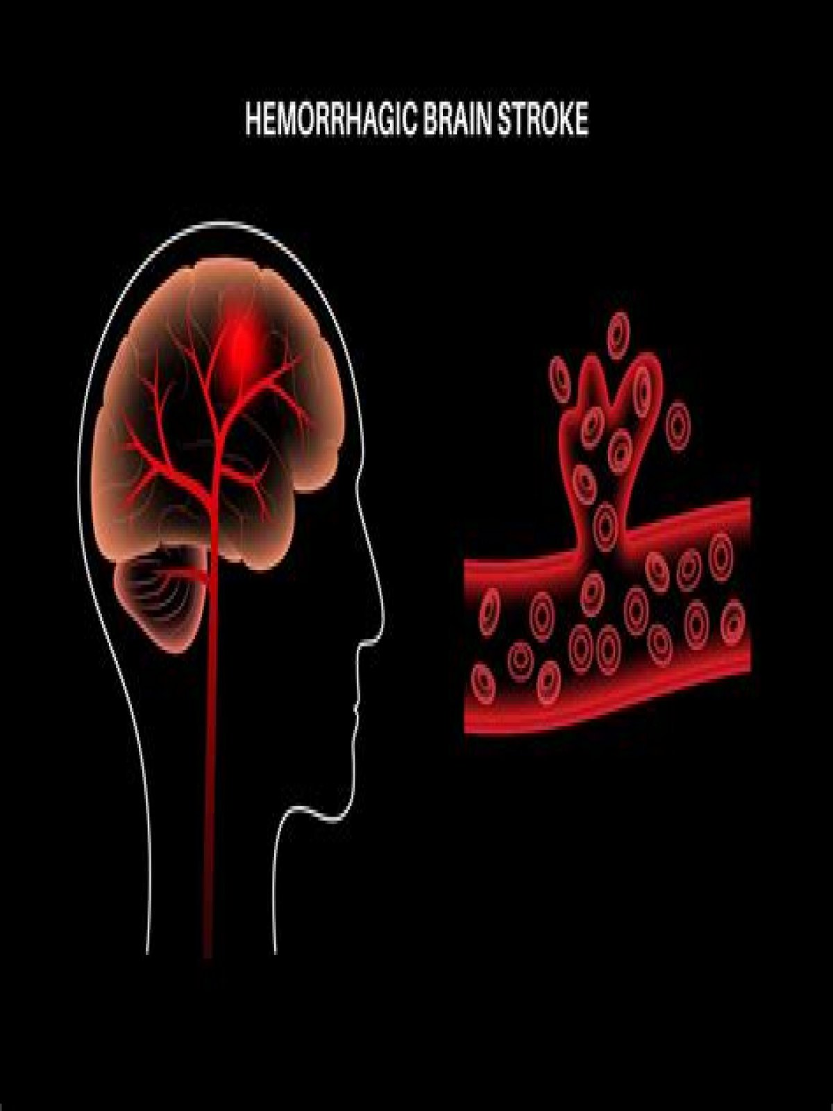 What are the chances of surviving a brain bleed stroke?